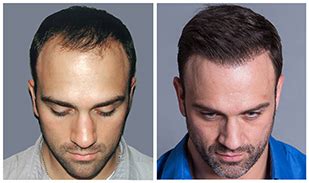 hair transplants st louis mo|Bosley Hair Transplant & Restoration .